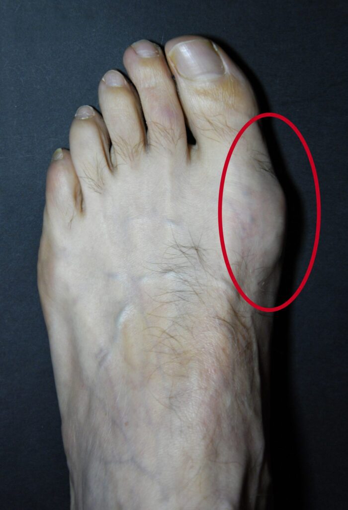 Imagen destacada para: Juanetes y Montaña: Guía Completa para Caminar sin Dolor