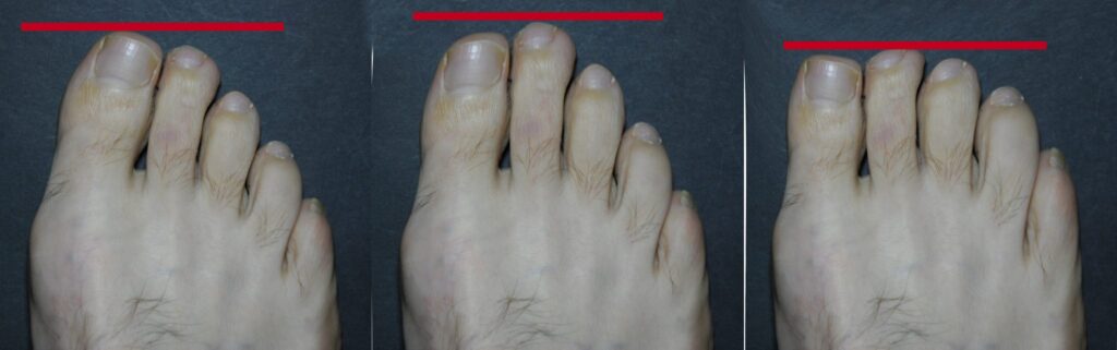 Tipos de pie: Egipcio, Griego y Romano